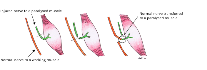 Diagram showing how a nerve transfer works